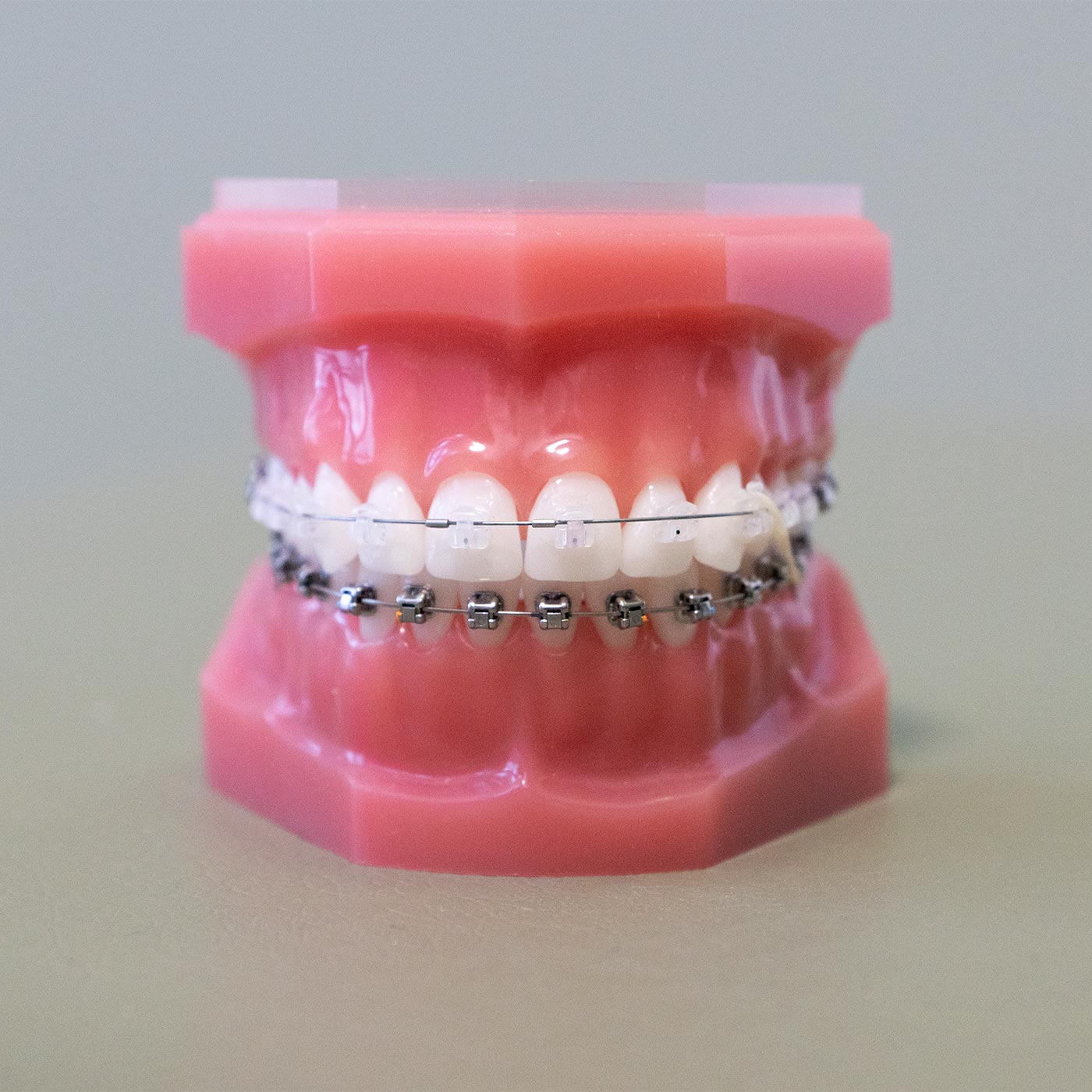 Praxis für ganzheitliche Kieferorthopädie & Funktionstherapie/CMD Berlin Zehlendorf | Festsitzende Zahnspange